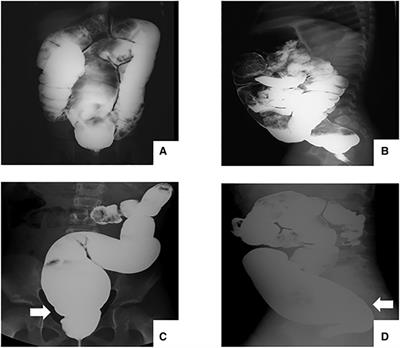 Comparison of clinical features and prognosis between ultrashort-segment and short-segment hirschsprung disease